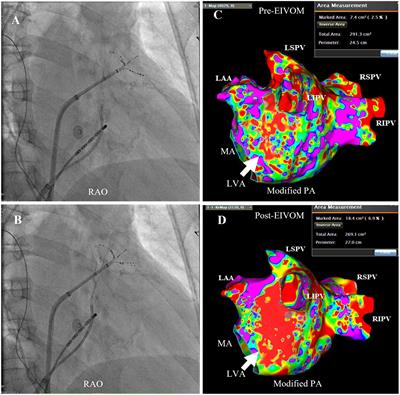 Impact of technical aspects of vein of Marshall ethanol infusion on mitral isthmus block for persistent atrial fibrillation ablation